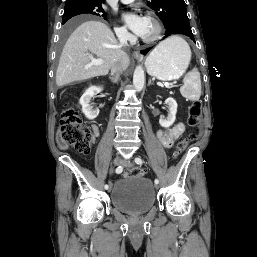Closed loop small bowel obstruction - adhesive disease and hemorrhagic ischemia (Radiopaedia 86831-102990 B 71).jpg