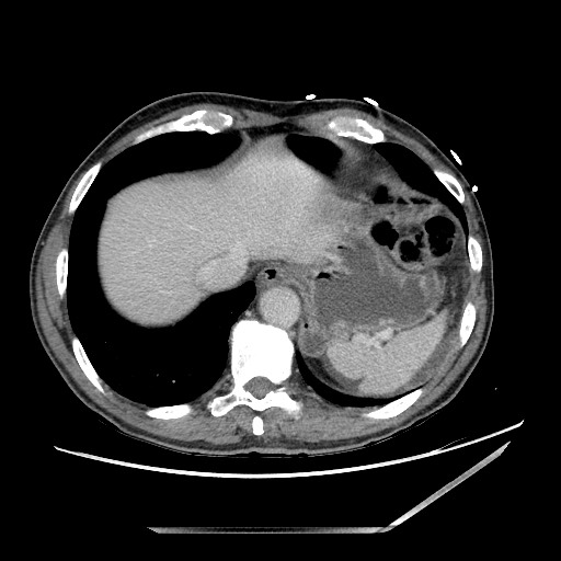 Closed loop small bowel obstruction - omental adhesion causing "internal hernia" (Radiopaedia 85129-100682 A 18).jpg