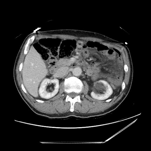 File:Closed loop small bowel obstruction - omental adhesion causing "internal hernia" (Radiopaedia 85129-100682 A 61).jpg