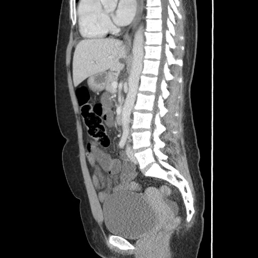 Closed loop small bowel obstruction due to trans-omental herniation (Radiopaedia 35593-37109 C 35).jpg