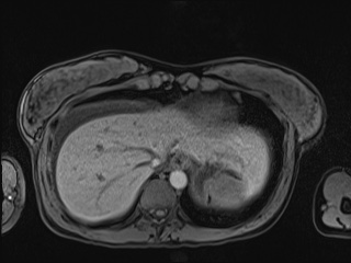 Closed loop small bowel obstruction in pregnancy (MRI) (Radiopaedia 87637-104031 Axial T1 fat sat 17).jpg