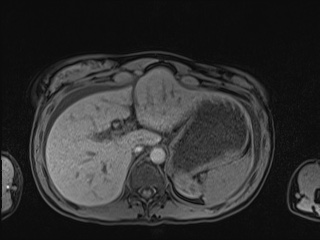 Closed loop small bowel obstruction in pregnancy (MRI) (Radiopaedia 87637-104031 Axial T1 fat sat 28).jpg