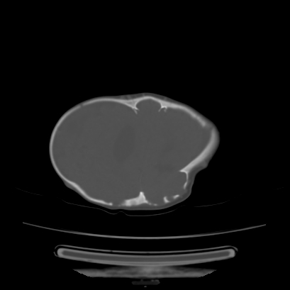 Cloverleaf skull (Radiopaedia 91901-109710 Axial bone window 119).jpg