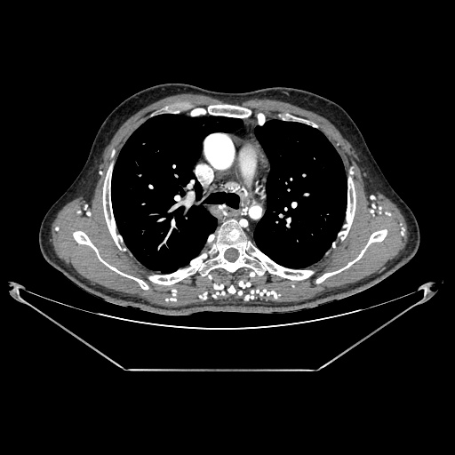 Coarctation of aorta (Radiopaedia 25384-25630 A 55).jpg
