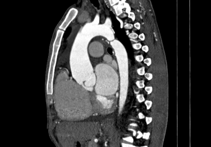 Coarctation of aorta with aortic valve stenosis (Radiopaedia 70463-80574 B 75).jpg