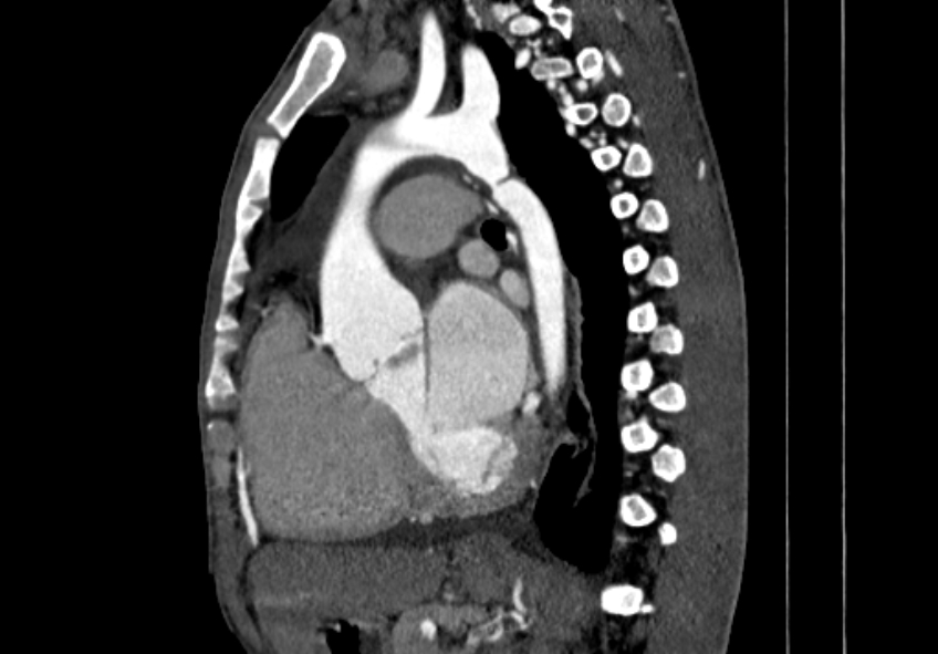 Coarctation of aorta with aortic valve stenosis (Radiopaedia 70463-80574 B 82).jpg