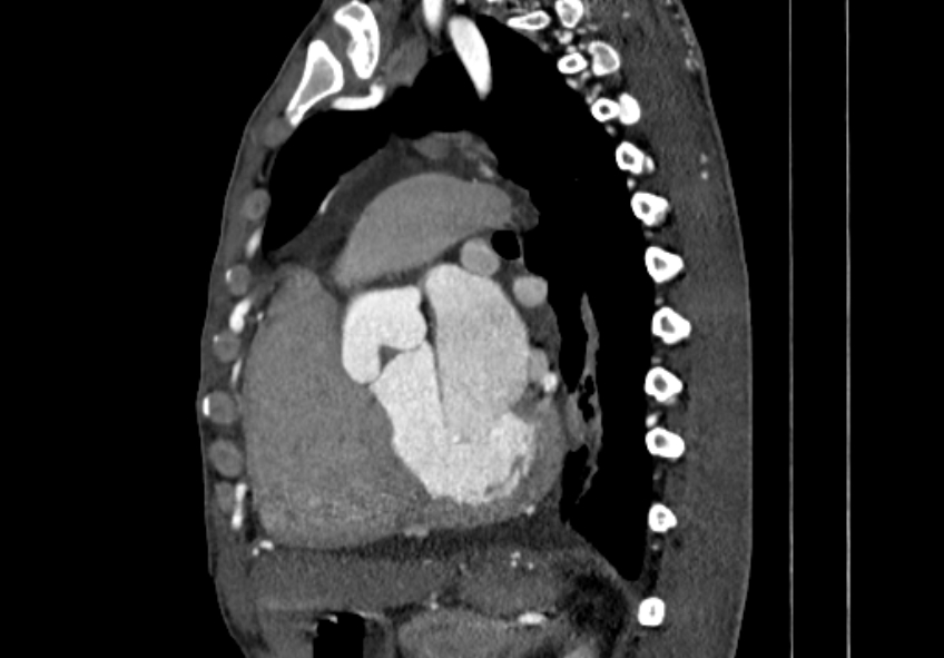 Coarctation of aorta with aortic valve stenosis (Radiopaedia 70463-80574 B 92).jpg
