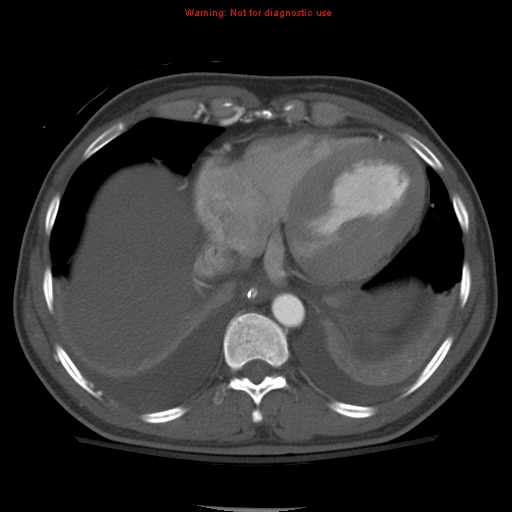 File:Coarctation of the aorta (Radiopaedia 8681-9490 B 47).jpg