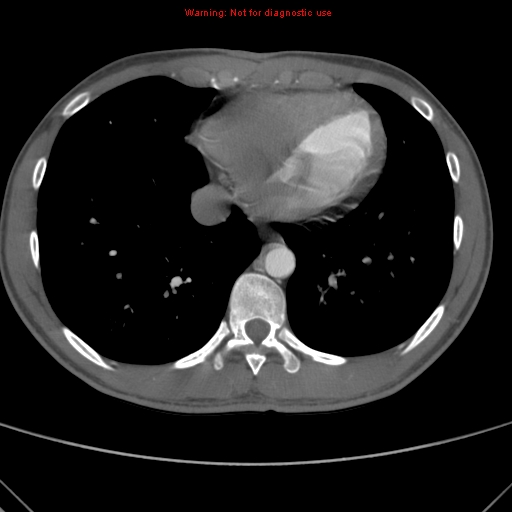 File:Coarctation of the aorta (Radiopaedia 9434-10118 A 145).jpg