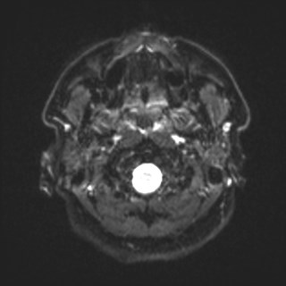 File:Cochlear incomplete partition type III associated with hypothalamic hamartoma (Radiopaedia 88756-105498 Axial DWI 1).jpg