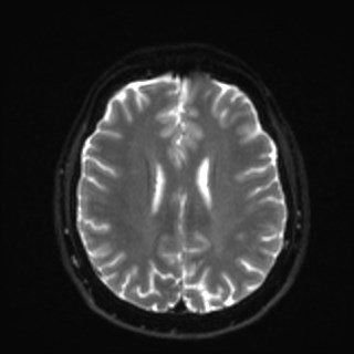 Cochlear incomplete partition type III associated with hypothalamic hamartoma (Radiopaedia 88756-105498 Axial DWI 27).jpg