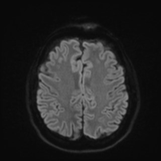 Cochlear incomplete partition type III associated with hypothalamic hamartoma (Radiopaedia 88756-105498 Axial DWI 69).jpg