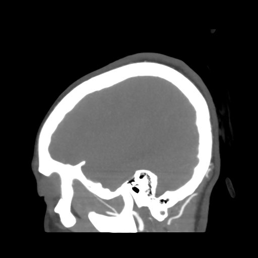 Colloid cyst (resulting in death) (Radiopaedia 33423-34499 B 46).png
