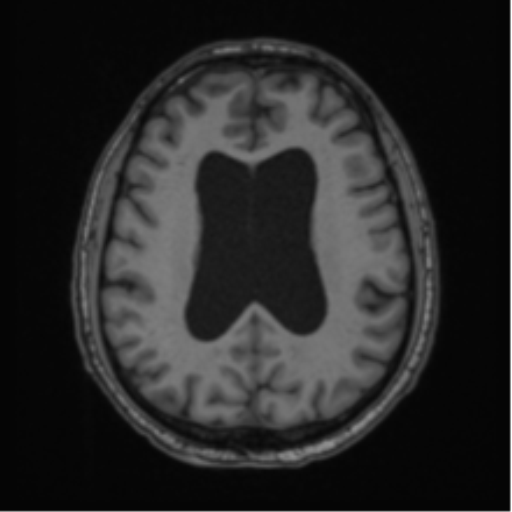 File:Colloid cyst of the third ventricle (Radiopaedia 86571-102662 Axial T1 50).png