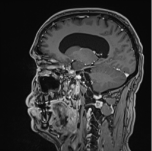 File:Colloid cyst of the third ventricle (Radiopaedia 86571-102662 Sagittal T1 C+ 31).png