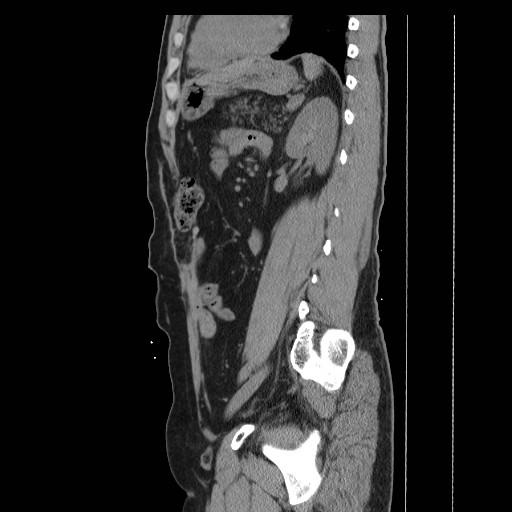 File:Colocutaneous fistula in Crohn's disease (Radiopaedia 29586-30093 C 38).jpg