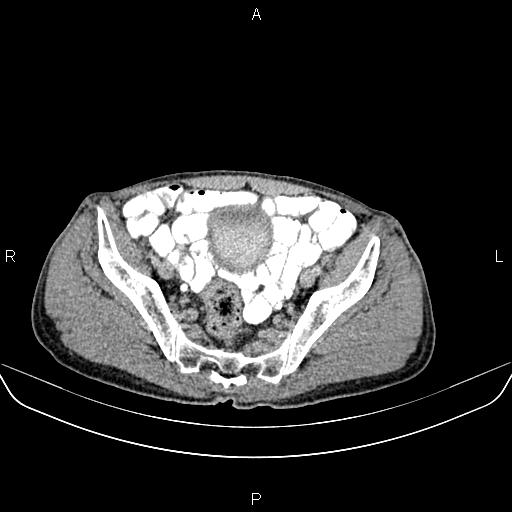File:Colon adenocarcinoma - hepatic flexure (Radiopaedia 85635-101395 Axial C+ delayed 79).jpg