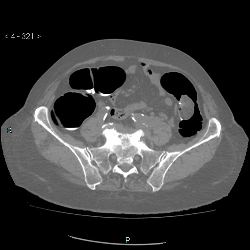 Colonic lipomas (Radiopaedia 49137-54244 Axial bone window 143).jpg