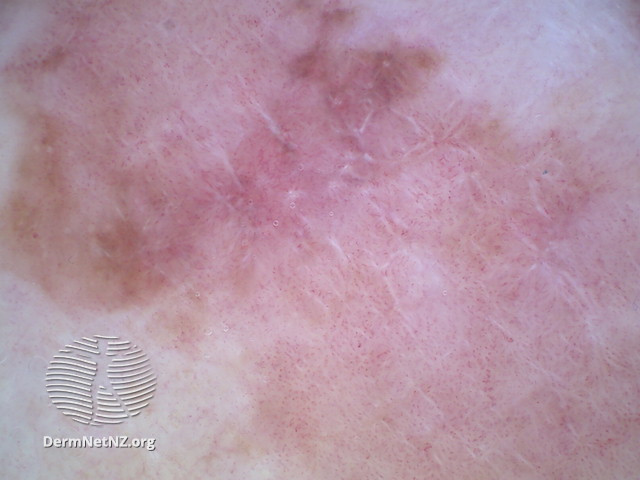 File:Dermoscopic image of amelanotic melanoma 6 (DermNet NZ amelanotic-melanoma5-dermoscopic).jpg