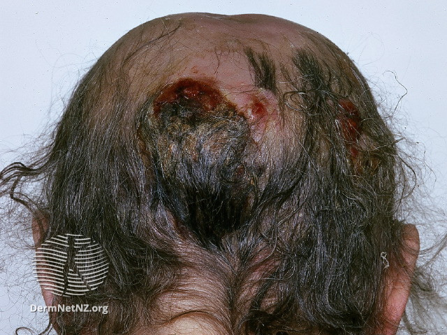File:Infected eczema (DermNet NZ cutaneous-hodgkin-001).jpg
