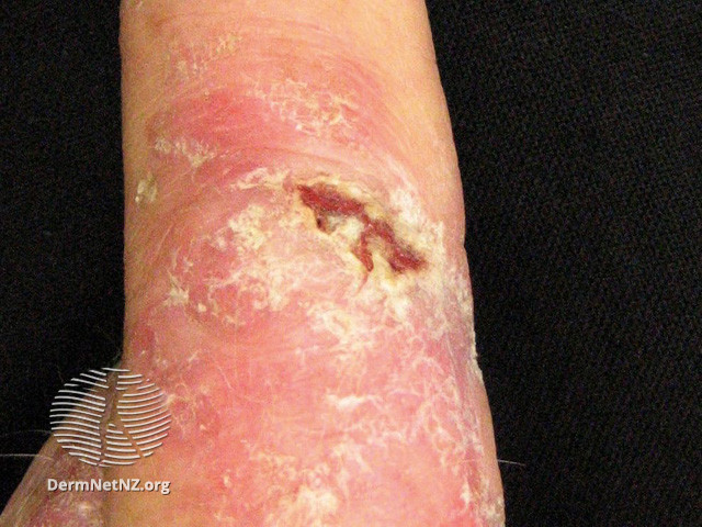 Intraepidermal carcinoma (DermNet NZ lesions-scc-in-situ-2973).jpg