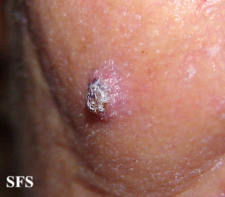 File:Keratoacanthoma (Dermatology Atlas 36).jpg