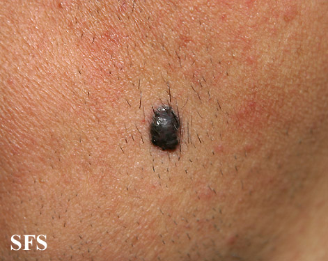 File:Melanoma (Dermatology Atlas 15).jpg