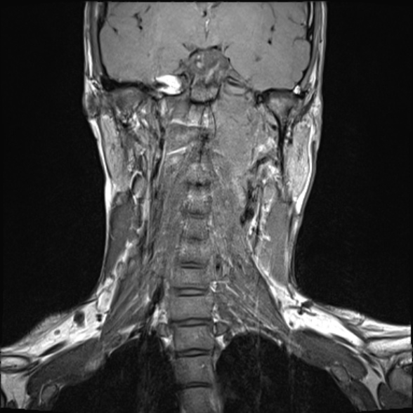 Nasopharyngeal carcinoma with skull base invasion (Radiopaedia 53415-59485 Coronal T1 16).jpg