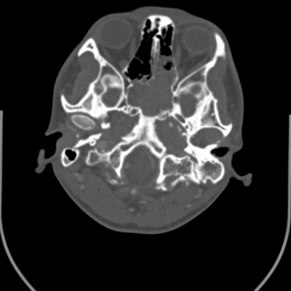 Nasopharyngeal carcinoma with skull base invasion (Radiopaedia 53415-59705 Axial bone window 25).jpg