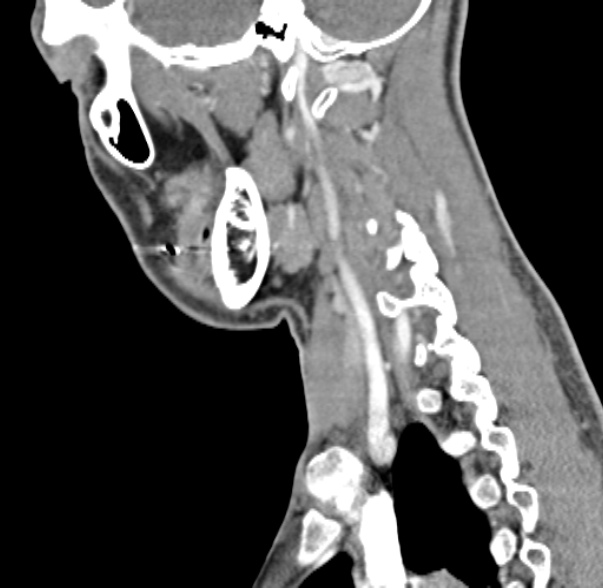 Nasopharyngeal carcinoma with skull base invasion (Radiopaedia 53415-59705 C 20).jpg