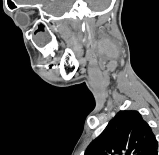 Nasopharyngeal carcinoma with skull base invasion (Radiopaedia 53415-59705 C 54).jpg