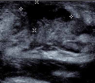 File:Neonatal mastitis with abscess (Radiopaedia 47089-51629 E 1).jpg