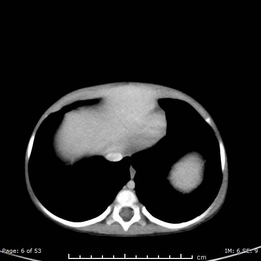 Nephroblastomatosis (Radiopaedia 41934-44935 A 6).jpg