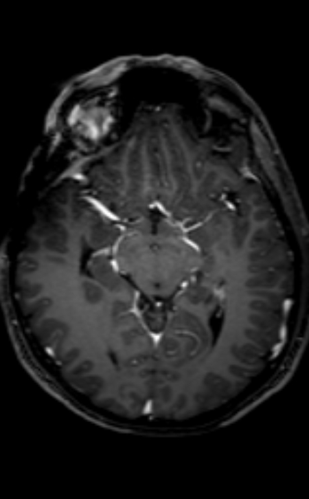 Neuro-Behçet disease (Radiopaedia 90112-107294 Axial T1 C+ 140).jpg