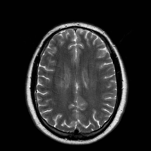 File:Neuro-Behcet's disease (Radiopaedia 21557-21505 Axial T2 15).jpg