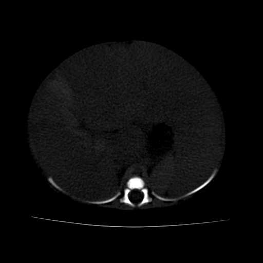 File:Neuroblastoma (Radiopaedia 20876-20799 Axial bone window 9).jpg