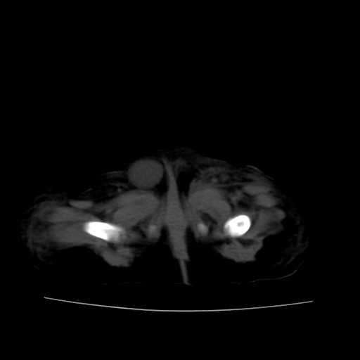 File:Neuroblastoma (Radiopaedia 20876-20799 Axial non-contrast 26).jpg