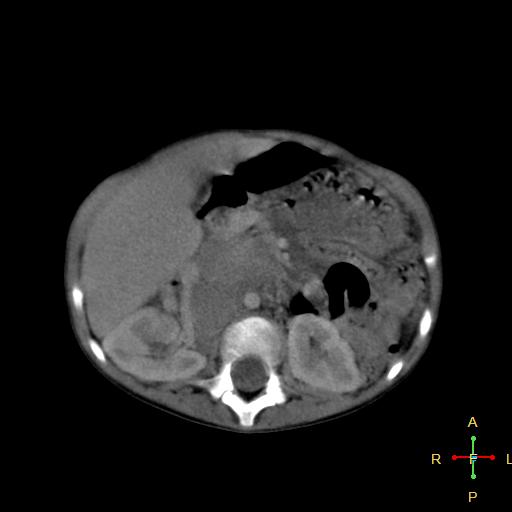 File:Neuroblastoma (Radiopaedia 24751-25016 D 18).jpg