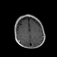 File:Neurofibromatosis type 1 (Radiopaedia 30089-30671 Axial T1 C+ 20).jpg