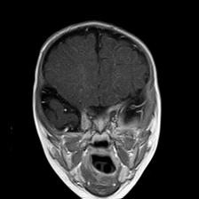 File:Neurofibromatosis type 1 (Radiopaedia 30089-30671 Coronal T1 C+ 9).jpg