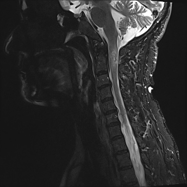 File:Neurofibromatosis type 1 (Radiopaedia 80355-93740 Sagittal STIR 6).jpg