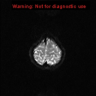 File:Neurofibromatosis type 1 with optic nerve glioma (Radiopaedia 16288-15965 Axial DWI 2).jpg