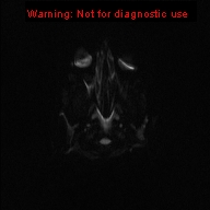 File:Neurofibromatosis type 1 with optic nerve glioma (Radiopaedia 16288-15965 Axial DWI 45).jpg