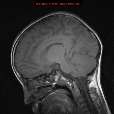 File:Neurofibromatosis type 1 with optic nerve glioma (Radiopaedia 16288-15965 Sagittal T1 11).jpg