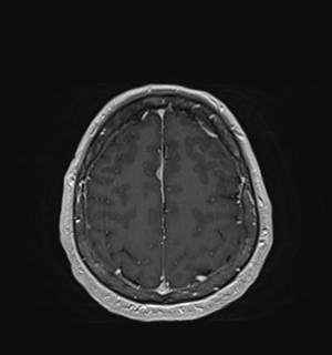 Neurofibromatosis type 2 (Radiopaedia 79097-92049 Axial T1 C+ 159).jpg