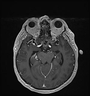 Neurofibromatosis type 2 (Radiopaedia 79097-92049 Axial T1 C+ 86).jpg