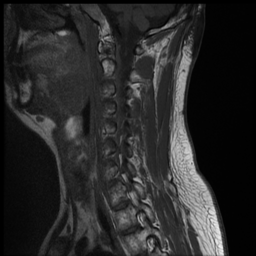 File:Neurofibromatosis type 2 (spinal manifestations) (Radiopaedia 53943-60070 Sagittal T1 4).png