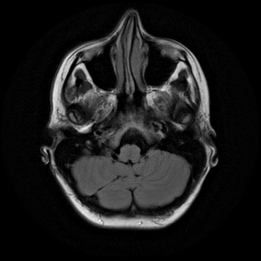 File:Neurofibromatosis type 2 - bilateral acoustic neuromata (Radiopaedia 40060-42566 Axial FLAIR 4).png