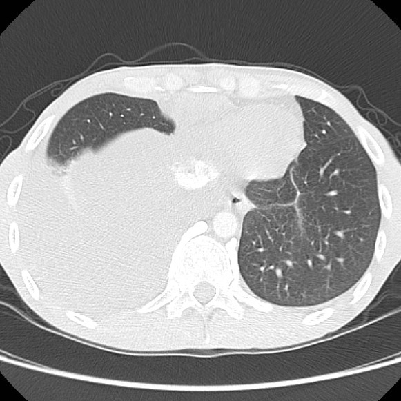 File:Non-Hodgkin lymphoma involving lung (Radiopaedia 29094-29470 Axial lung window 55).jpg