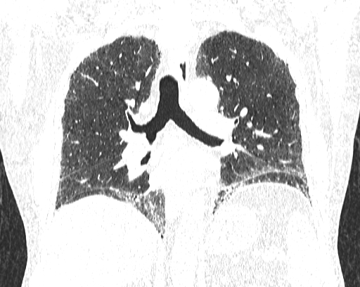 Non-specific interstitial pneumonia (NSIP) (Radiopaedia 68599-78228 Coronal lung window 55).jpg